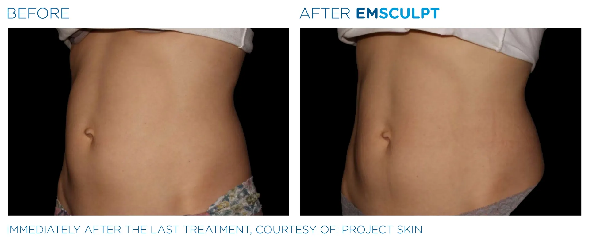 Emsculpt_PIC_Ba-card-female-abdomen-069_For-neo_ENUS100