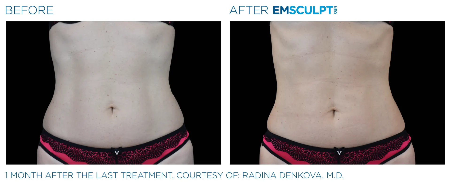 Emsculpt_neo_PIC_Ba-card-female-abdomen-018_EN100